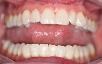 The 101 Guide to Teeth Whitening Johannesburg (2025, BIOLASE® & Take-Home Trays)