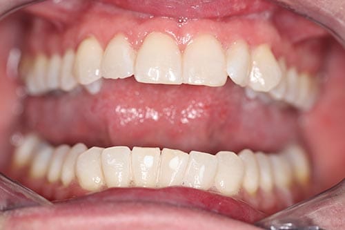 Professional Teeth Whitening after at Dr Chalita le Roux, Roodepoort