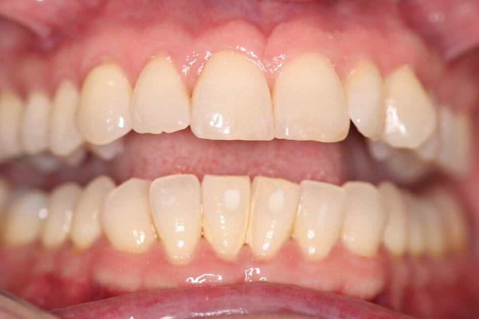 Before teeth whitening at Dr Chalita le Roux Dental Practice in Roodepoort