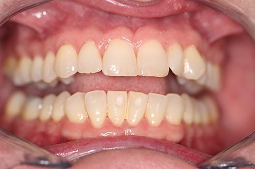 Professional Teeth Whitening before at Dr Chalita le Roux, Roodepoort