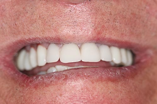 Smile Makeover Halfway: Upper Crowns & Bridge after at Dr Chalita le Roux, Roodepoort (view 1)