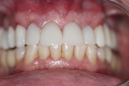 Smile Makeover Halfway: Upper Crowns & Bridge after at Dr Chalita le Roux, Roodepoort (view 2)
