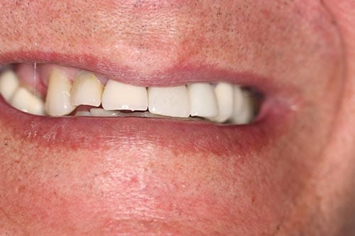 Smile Makeover Halfway: Upper Crowns & Bridge before at Dr Chalita le Roux, Roodepoort (view 1)
