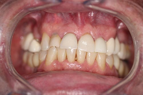 Smile Makeover Halfway: Upper Crowns & Bridge before at Dr Chalita le Roux, Roodepoort (view 2)