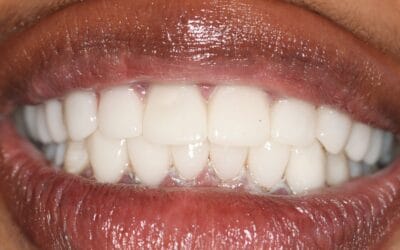 Smile Makeover vs Veneers vs Crowns: What’s the Difference? (Johannesburg Guide)