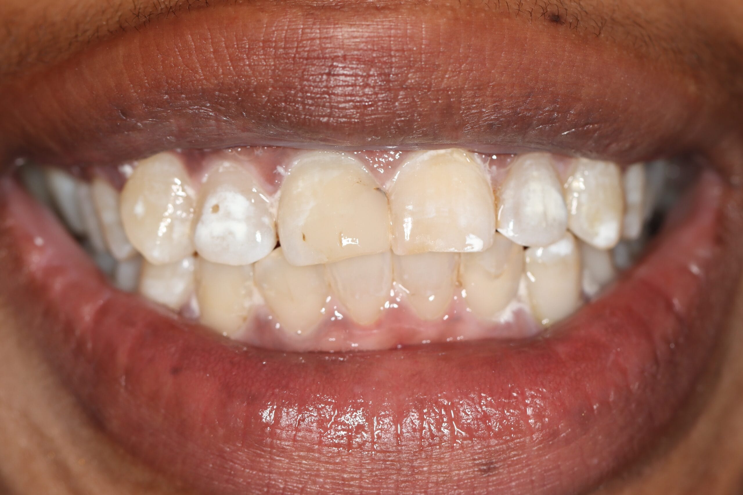 Before smile makeover showing worn and discoloured teeth before crown restoration at Dr Chalita le Roux Dental Studio Johannesburg