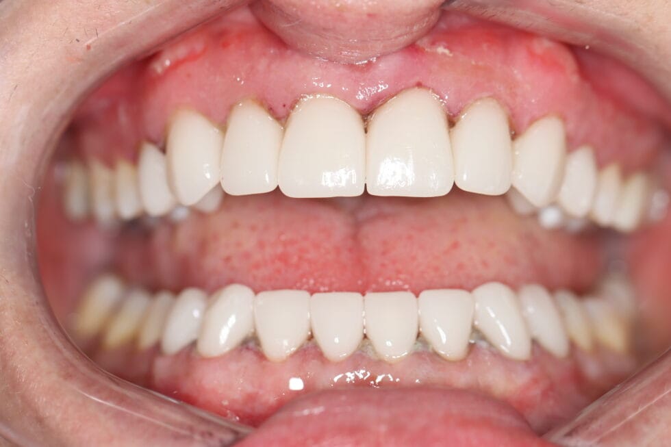 Smile makeover timeline Johannesburg - before and after crowns and veneers with same-day dentistry