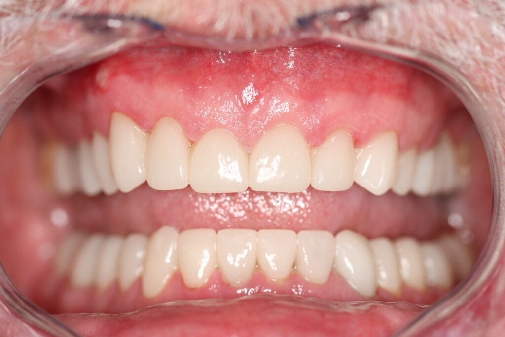 smile makeover before and after