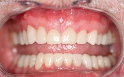 Smile Makeover Before and After in Johannesburg: Real Results and What to Expect