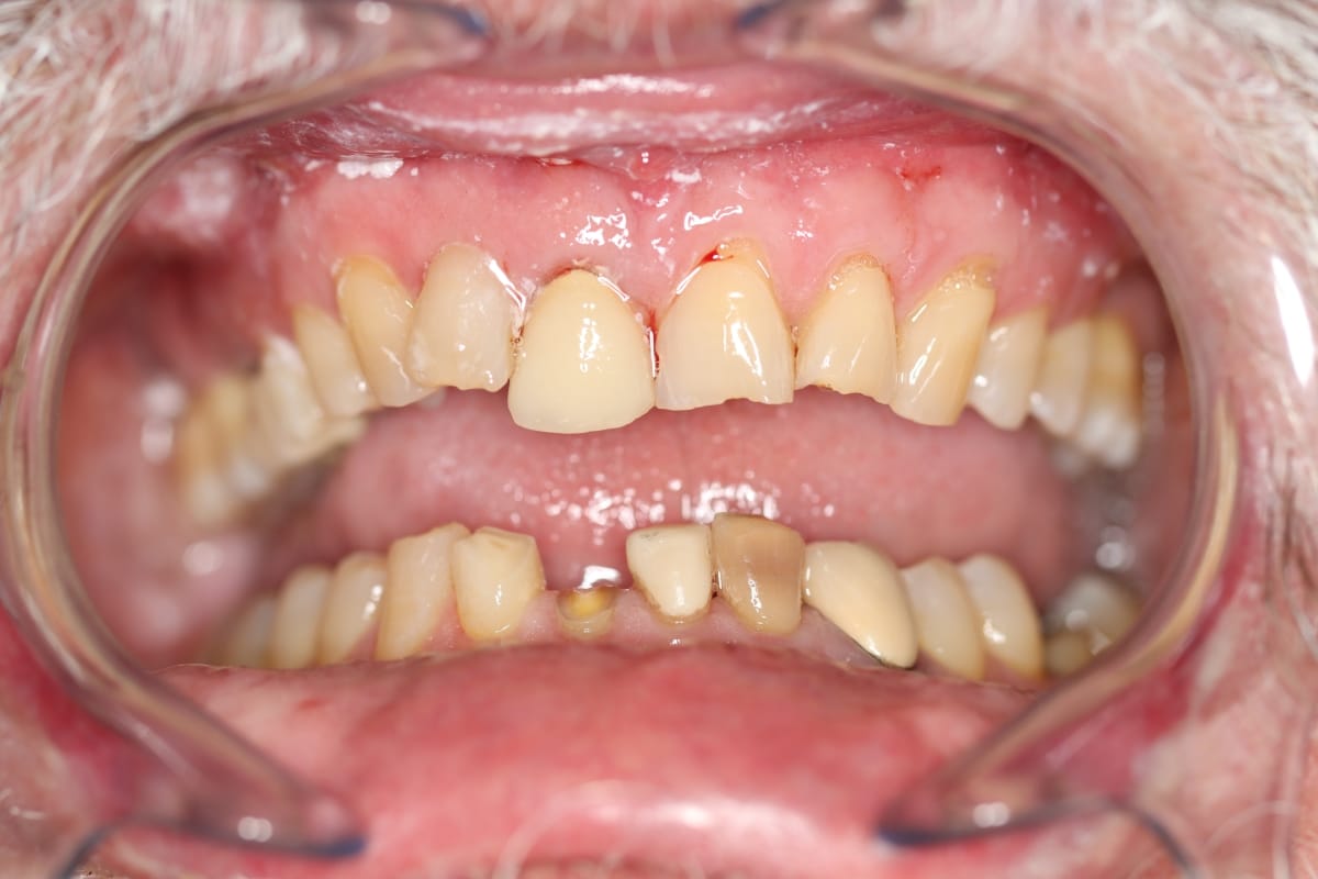 COSMETIC DENTISTRY 3 Cosmetic dentistry before smile makeover outcome