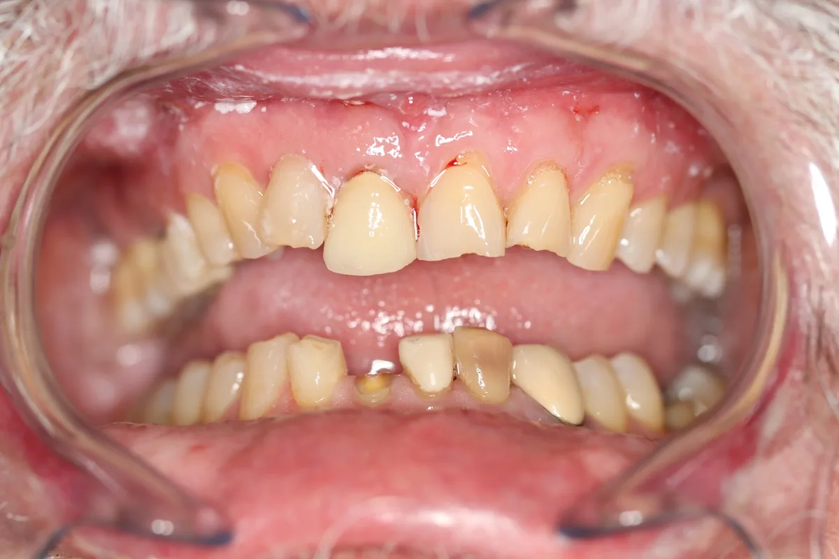 Cosmetic dentistry before smile makeover outcome