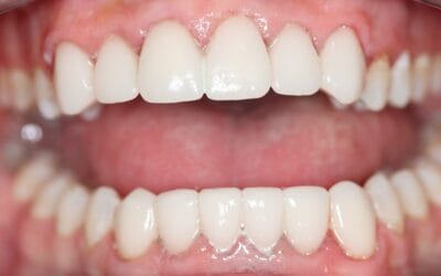 Same-Day Smile Makeovers in Johannesburg: How Digital Dentistry Works