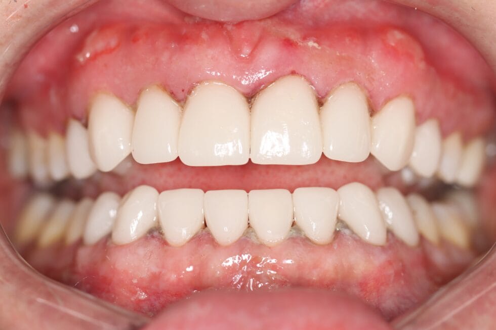 How Long Does a Smile Makeover Last? (Johannesburg Guide) 1 How long does a smile makeover last?
