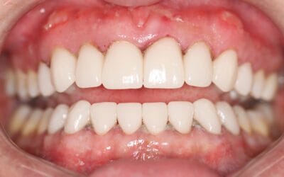 How Long Does a Smile Makeover Last? (Johannesburg Guide)