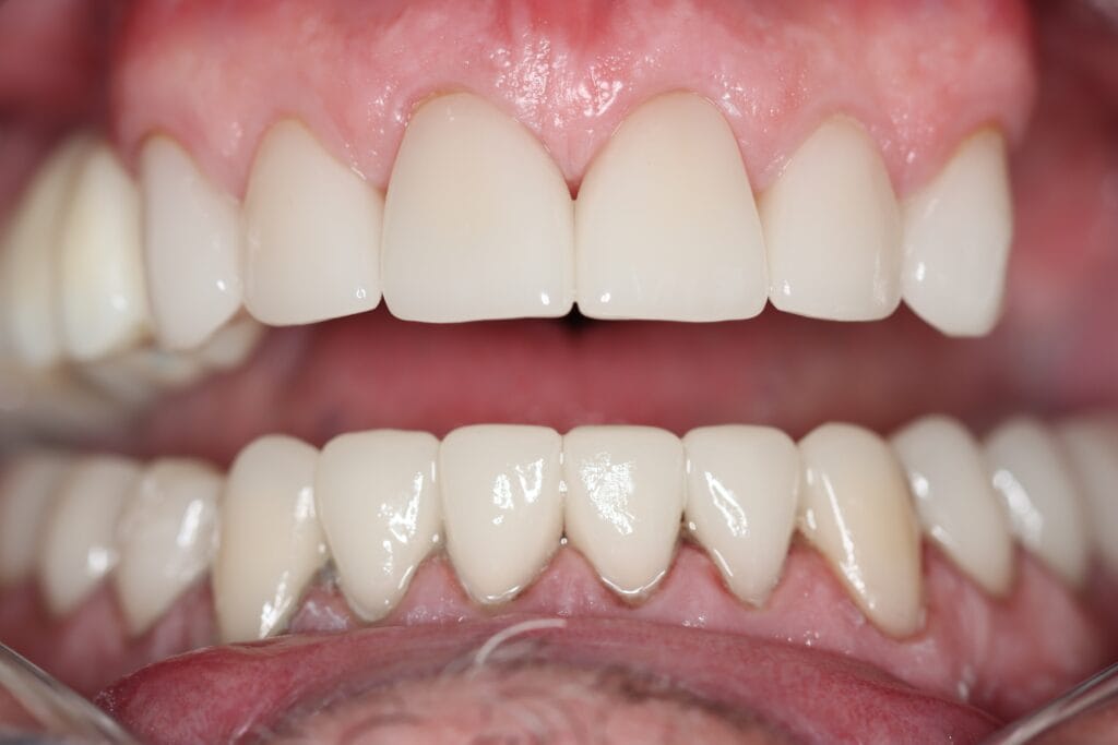 Smile makeover process Johannesburg 2025 – same-day crowns full mouth before and after
