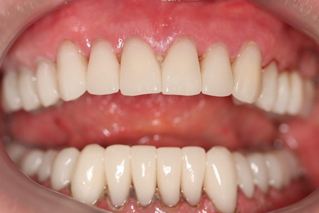 after full smile makeover johannesburg dr chalita le roux upper and lower emax crowns