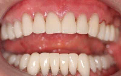 101 Smile Makeover Johannesburg: Cost & Same-Day Crowns