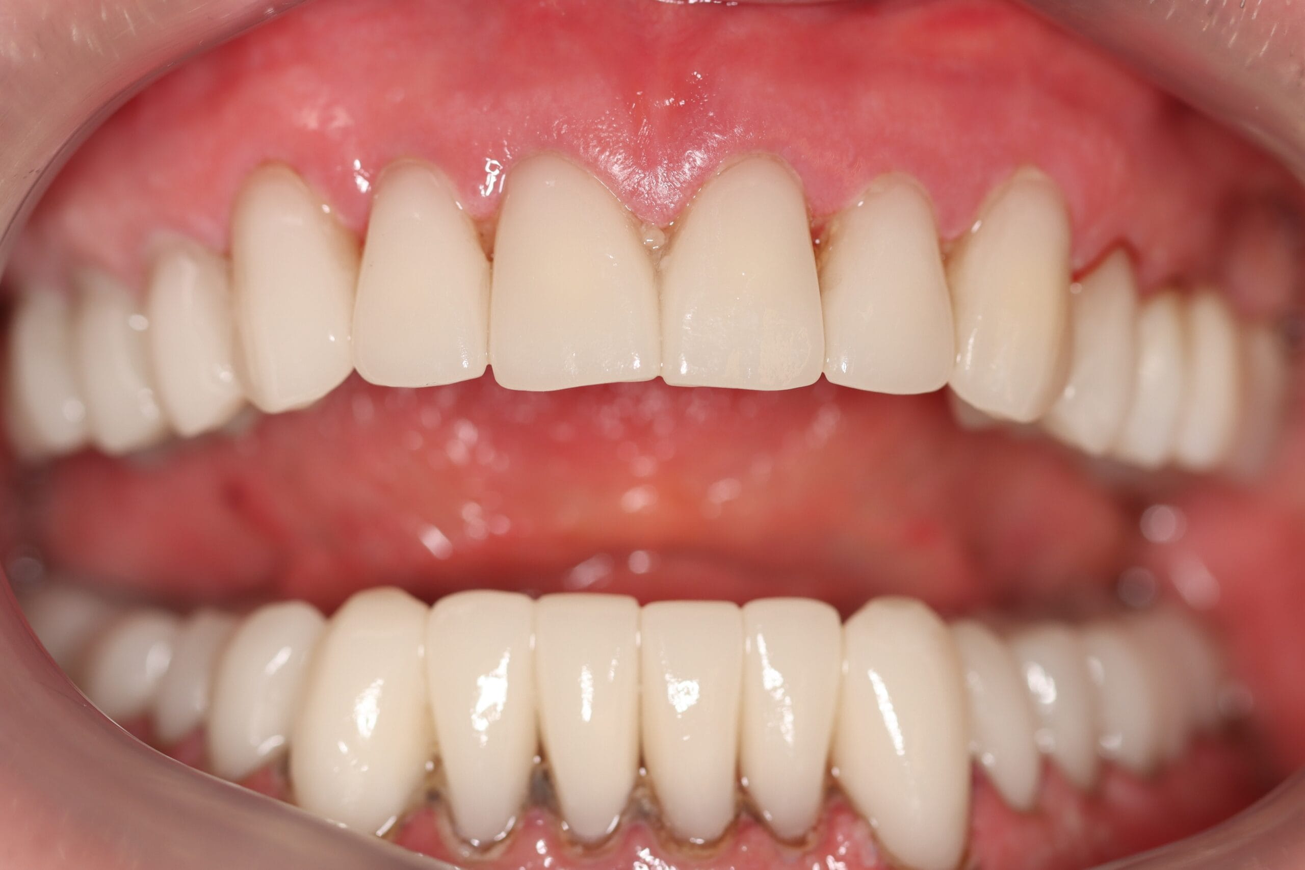 Cosmetic Dentistry Smile Makeover – After Cosmetic dentistry after smile makeover outcome