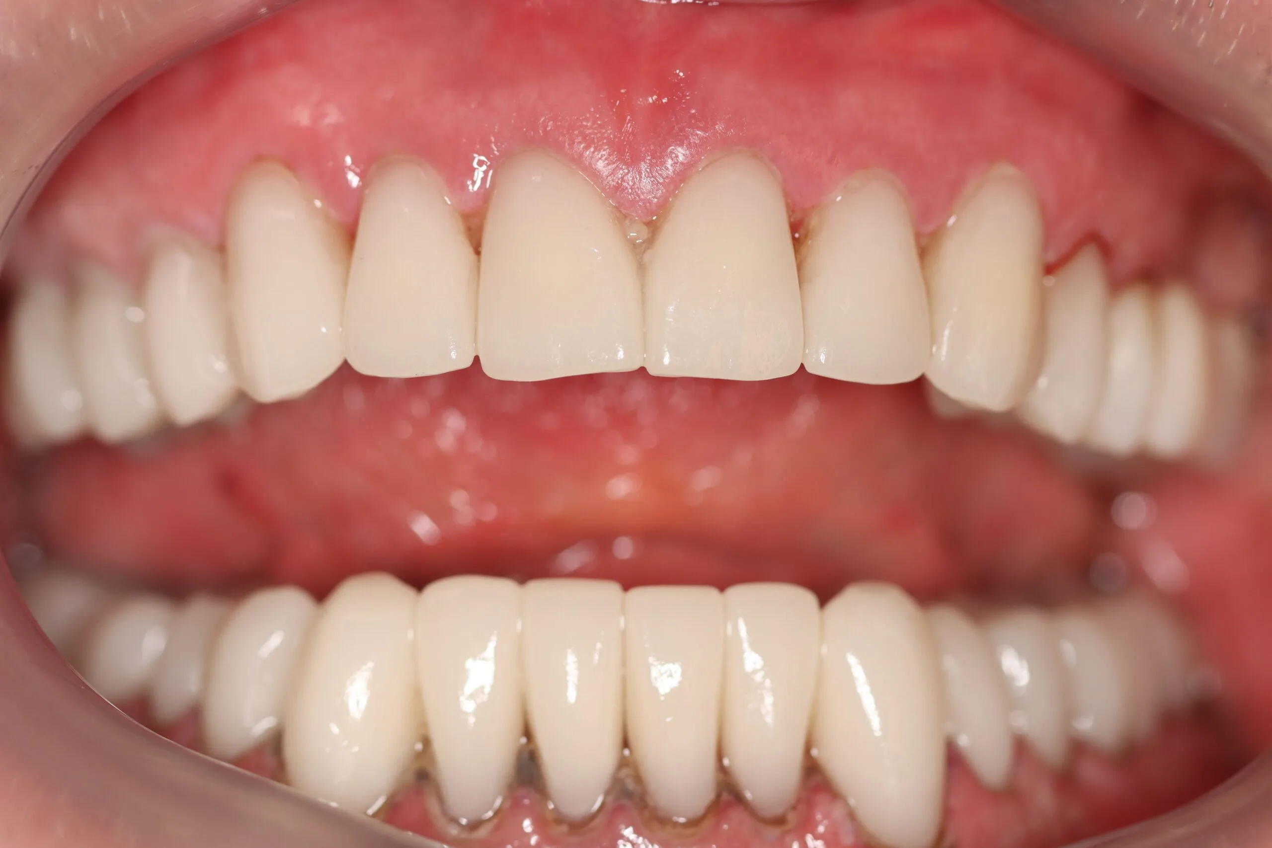 Cosmetic dentistry after smile makeover outcome
