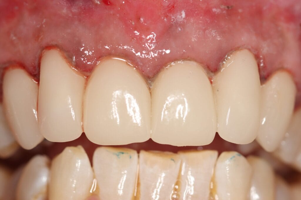 🦷 Smile Makeover Procedure | Dr Chalita le Roux Johannesburg 2 after smile makeover Johannesburg – six upper Emax crowns same-day by Dr Chalita le Roux using CAD/CAM