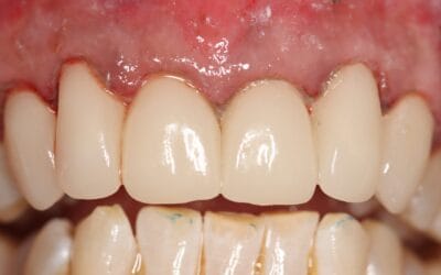🦷 Smile Makeover Procedure | Dr Chalita le Roux Johannesburg