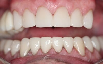 5 Steps of a Smile Makeover Process in Johannesburg (2025)