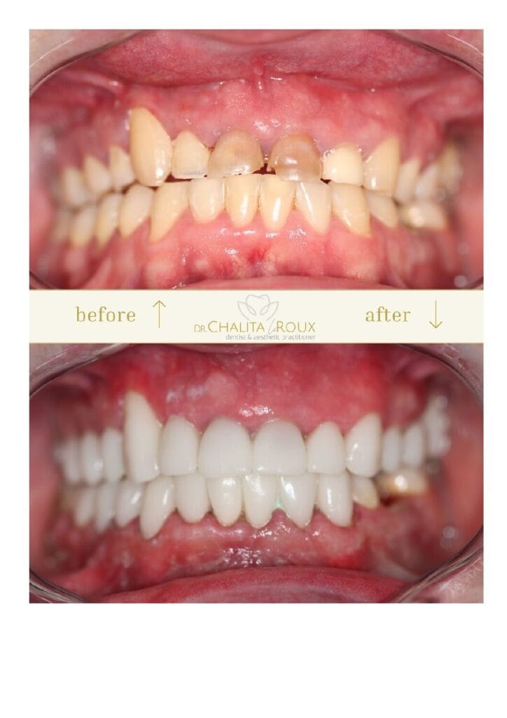 Smile Makeover Before and After by Dr Chalita Le Roux in Roodepoort