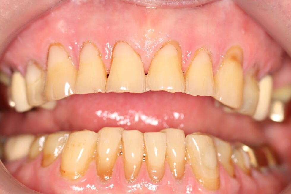 before smile makeover johannesburg dr chalita le roux – worn yellow teeth upper and lower arches