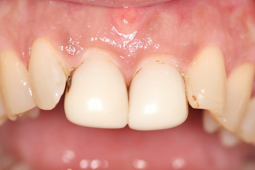 🦷 Smile Makeover Procedure | Dr Chalita le Roux Johannesburg 1 before smile makeover procedure Johannesburg – thick composite teeth before Emax crowns