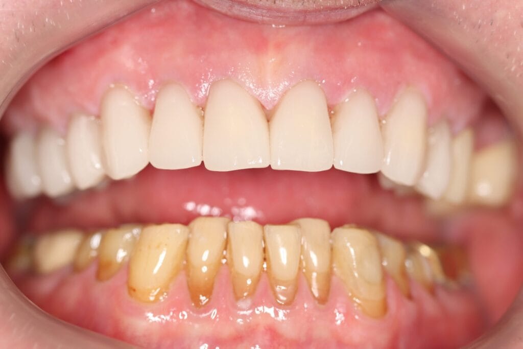 upper arch emax dental crowns johannesburg dr chalita le roux smile makeover progress