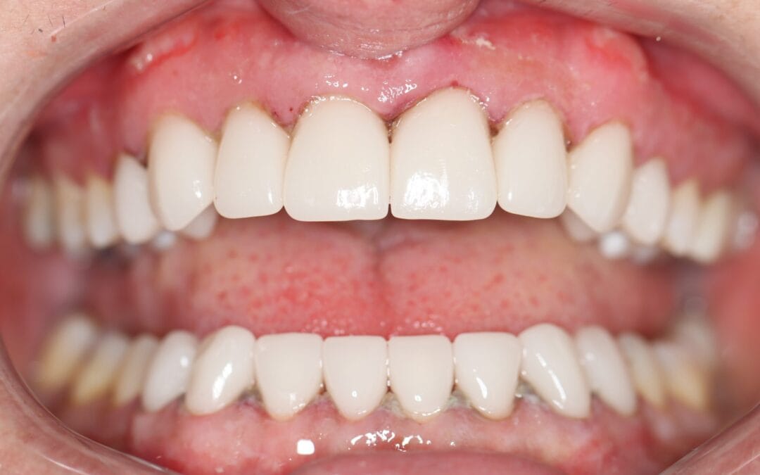 Smile Makeover Johannesburg | Cosmetic Dentist Dr Chalita le Roux