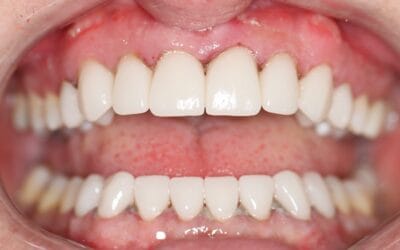 🦷 Smile Makeover Johannesburg | Transform Your Smile with Dr Chalita Le Roux