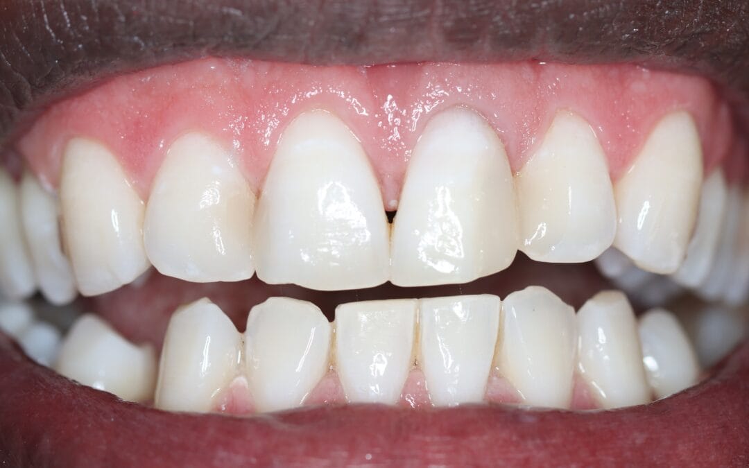 Professional Teeth Whitening Johannesburg — Your Complete Guide to a Brighter, Confident Smile