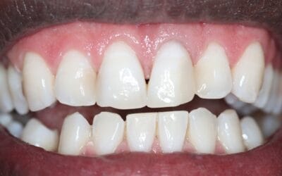 Professional Teeth Whitening Johannesburg — Your Complete Guide to a Brighter, Confident Smile