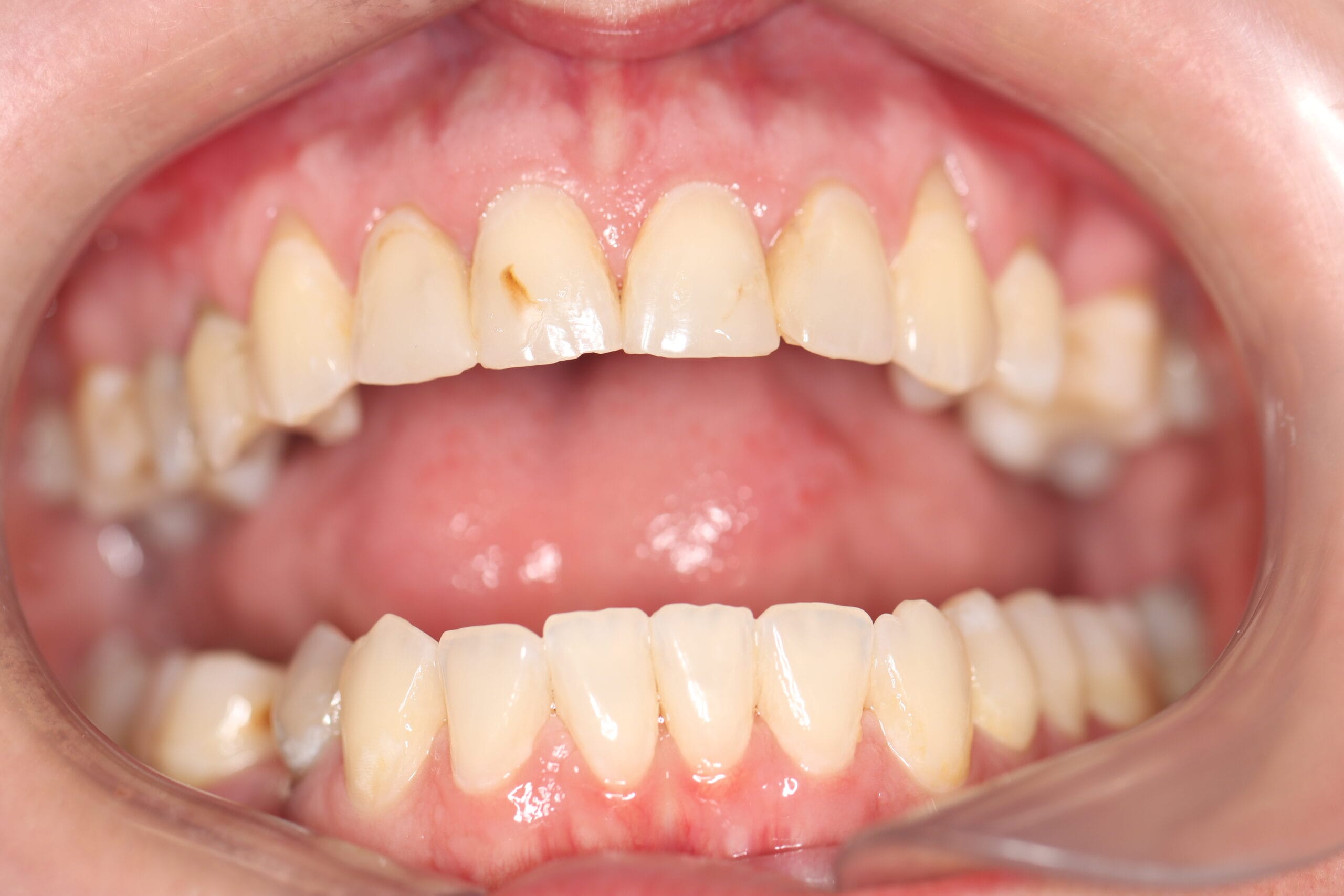 Teeth whitening before treatment in Roodepoort Johannesburg dental practice
