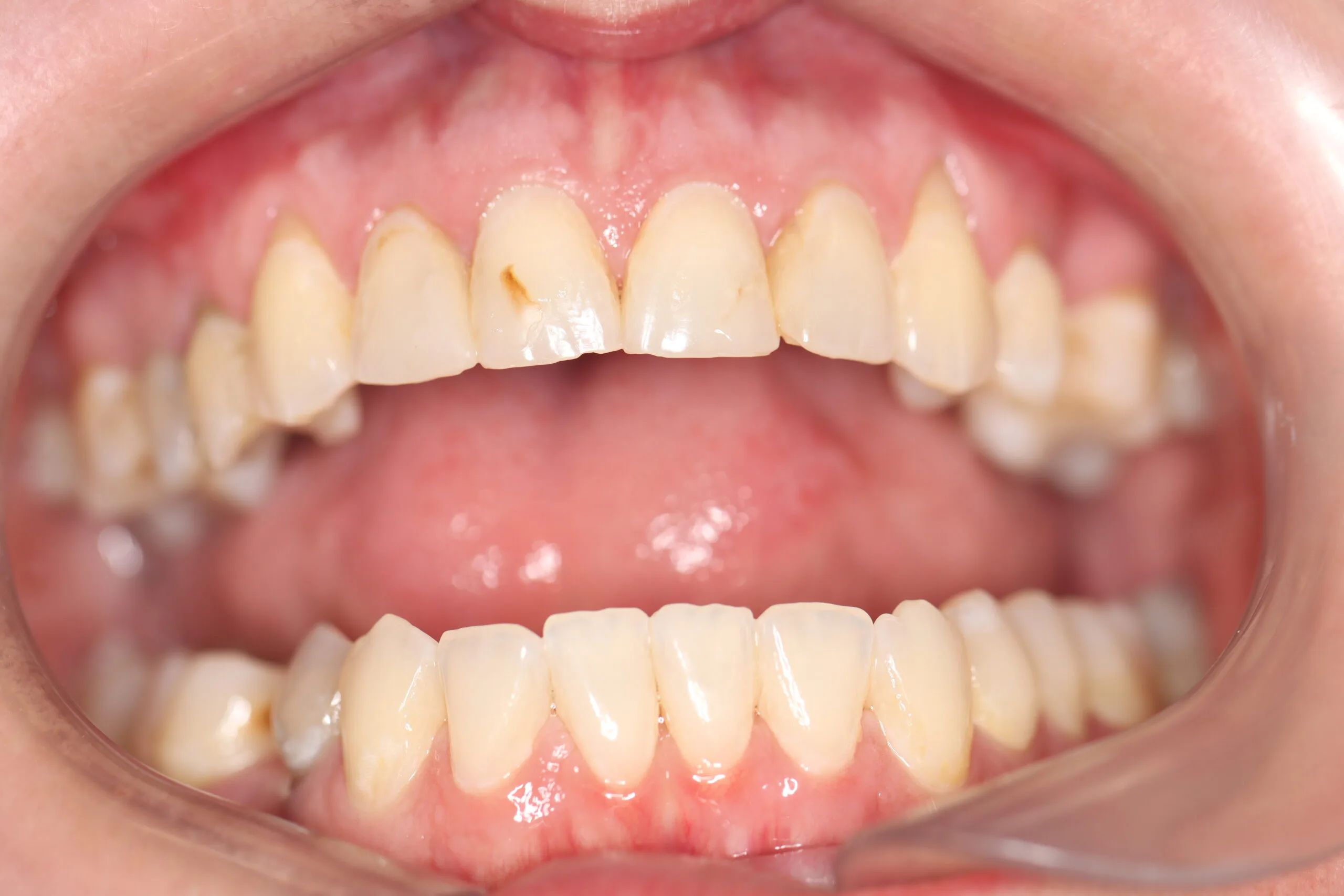 Teeth whitening before treatment in Roodepoort Johannesburg dental practice
