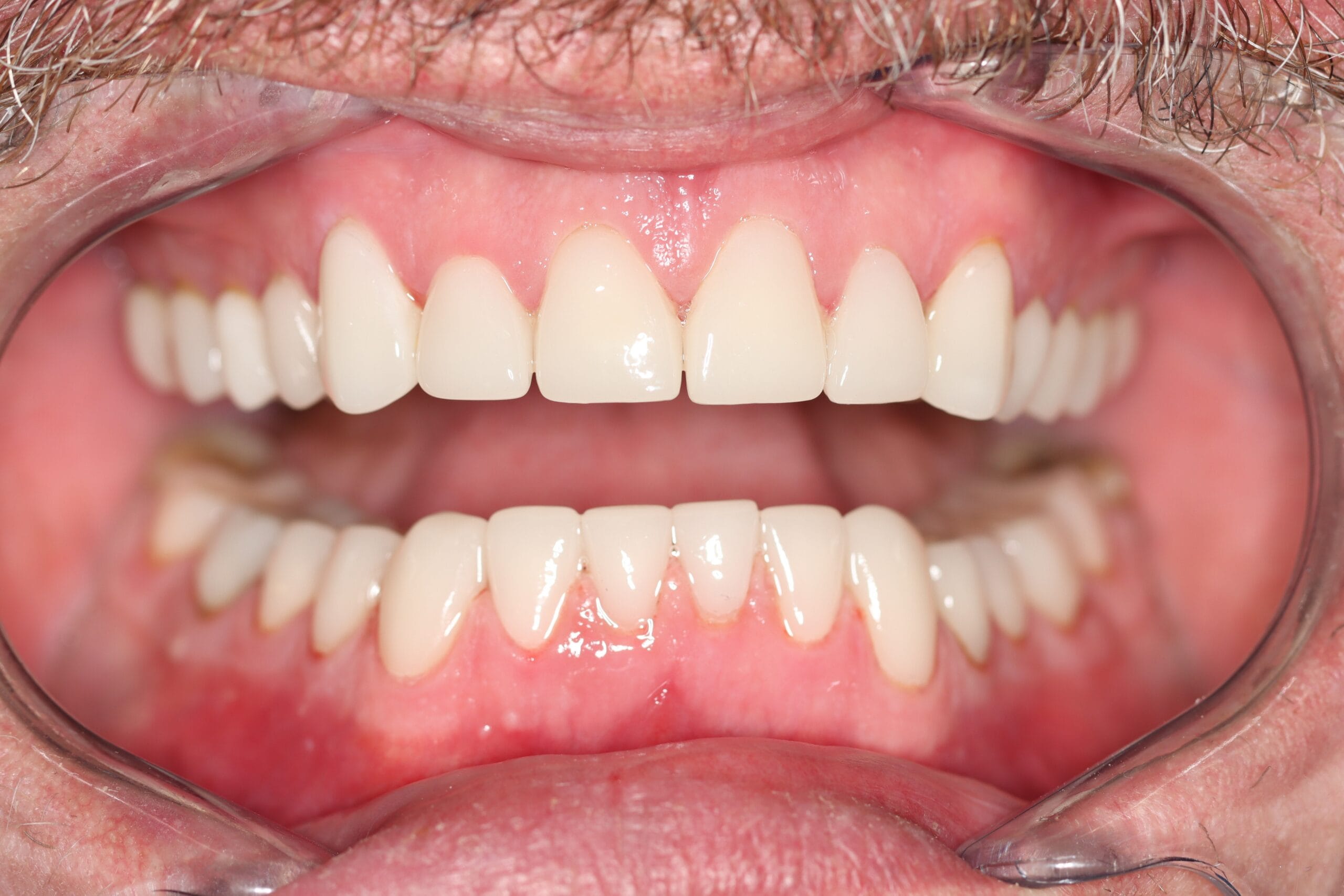 After Smile Makeover Cosmetic Dentistry Clinical Dr Chalita le Roux scaled