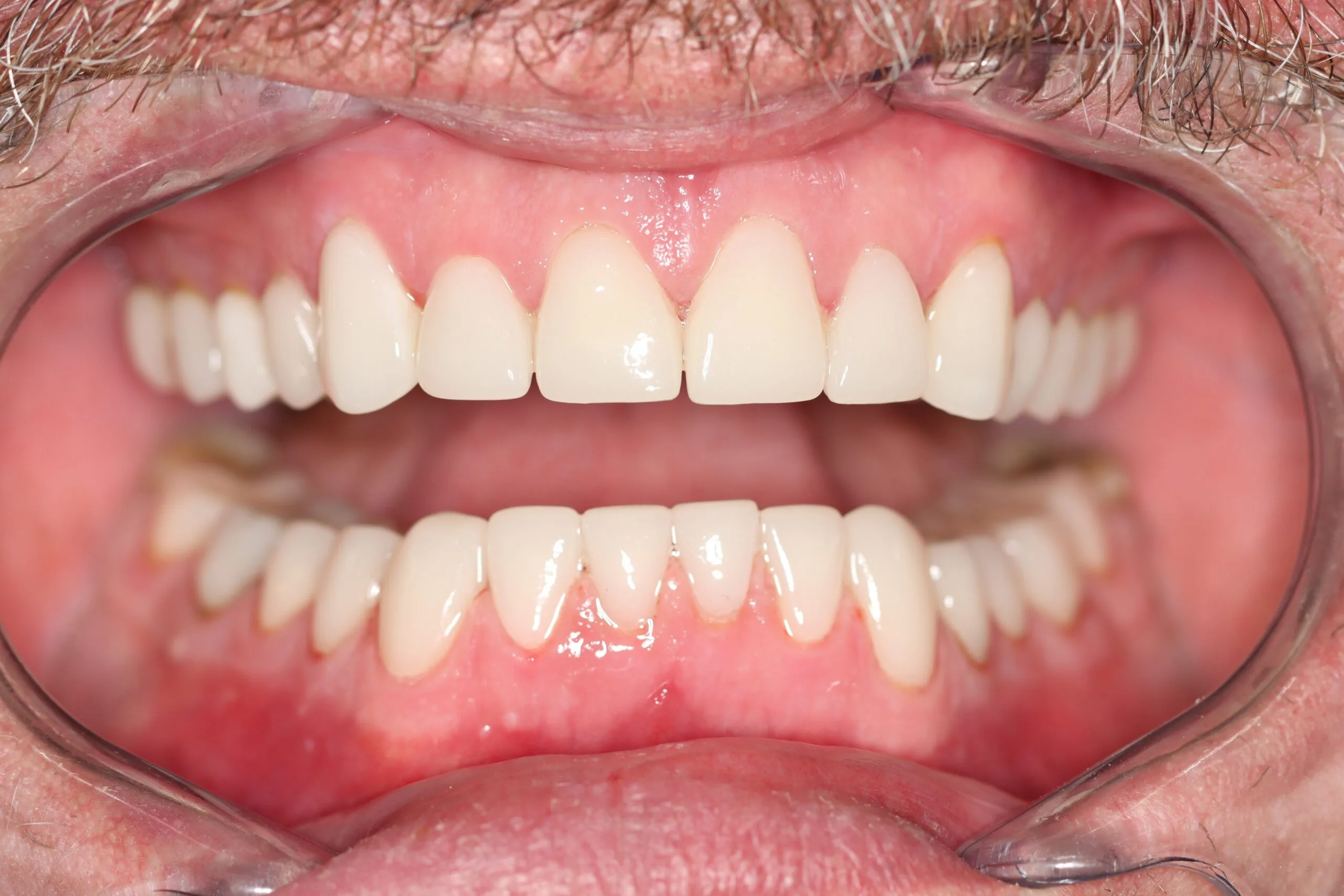 After Smile Makeover Cosmetic Dentistry Clinical Dr Chalita le Roux scaled