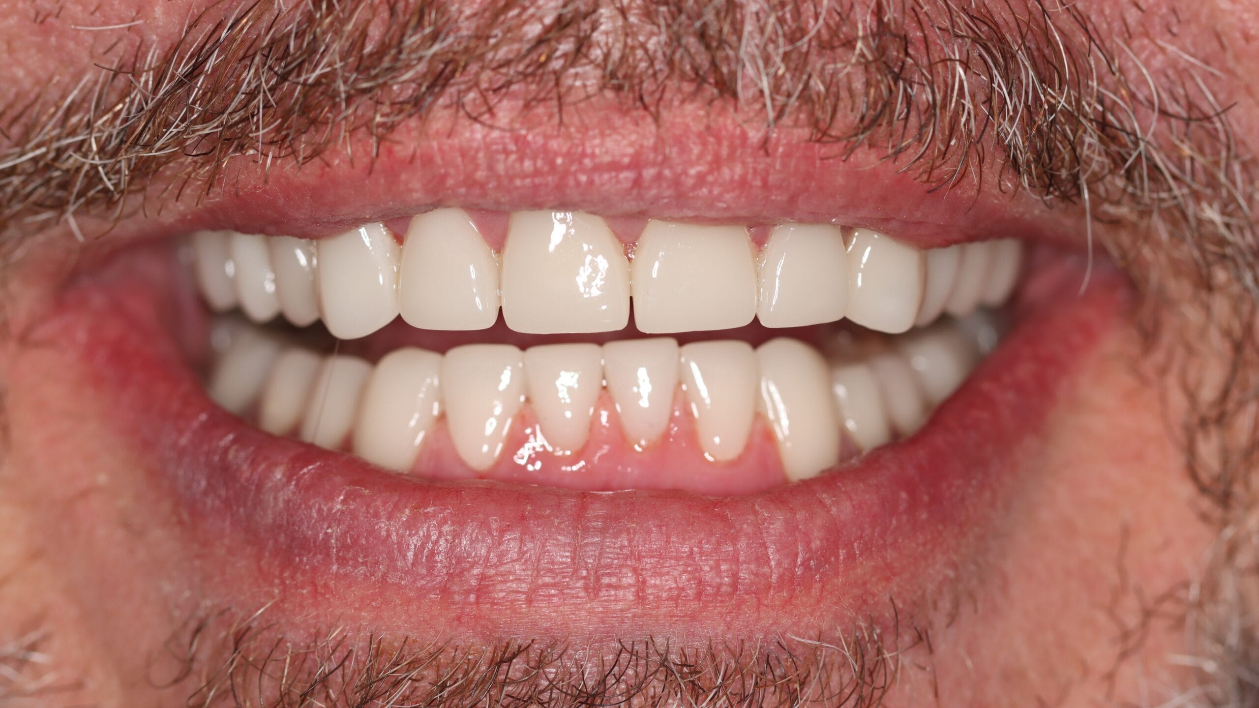 Smile Makeover Cosmetic Dentistry Natural Dr Chalita le Roux Smile Makeover treatment in Roodepoort achieving improved tooth shade and symmetry through cosmetic dentistry.