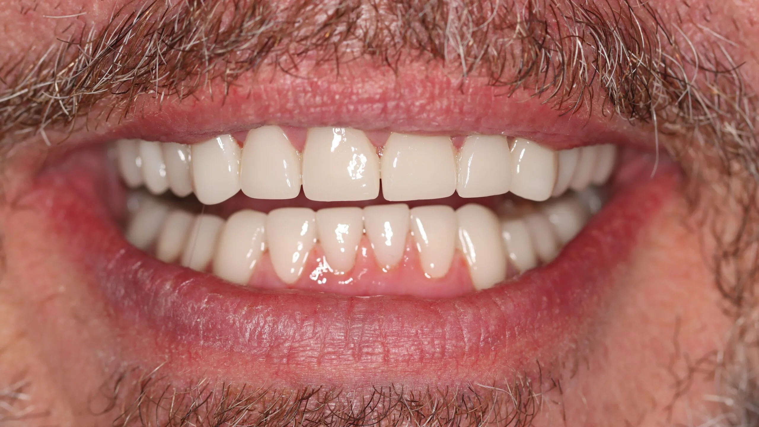 Smile Makeover treatment in Roodepoort achieving improved tooth shade and symmetry through cosmetic dentistry.
