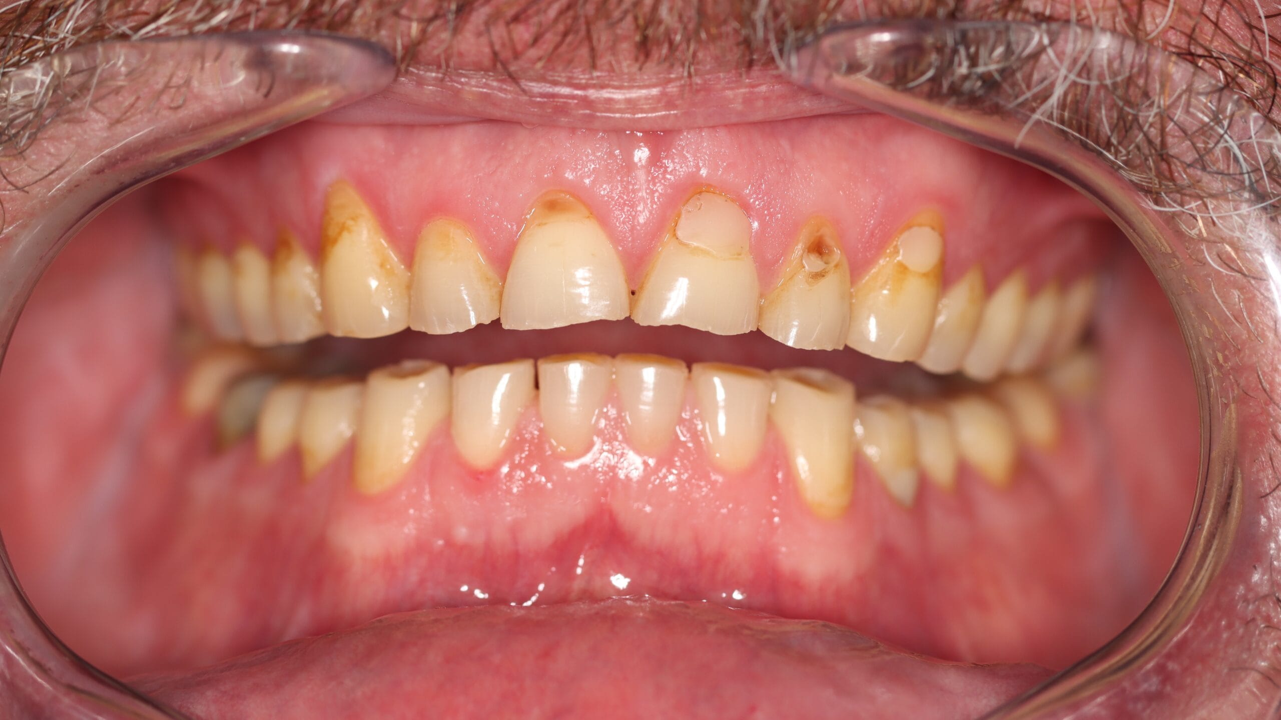 Before Smile Makeover Cosmetic Dentistry Clinical Dr Chalita le Roux scaled