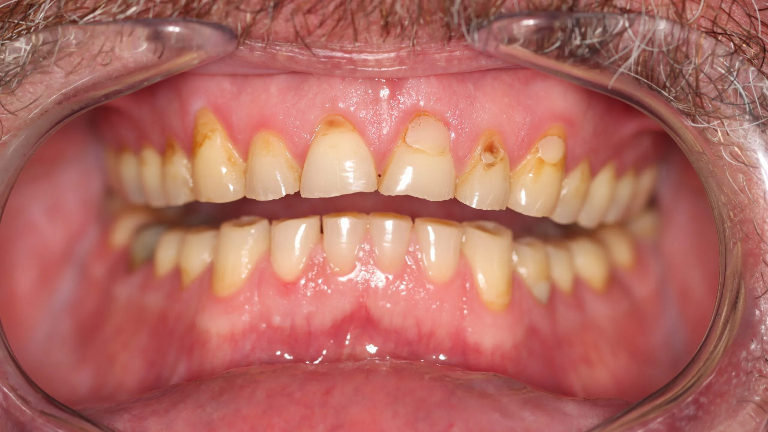 Before Smile Makeover Cosmetic Dentistry Clinical Dr Chalita le Roux scaled