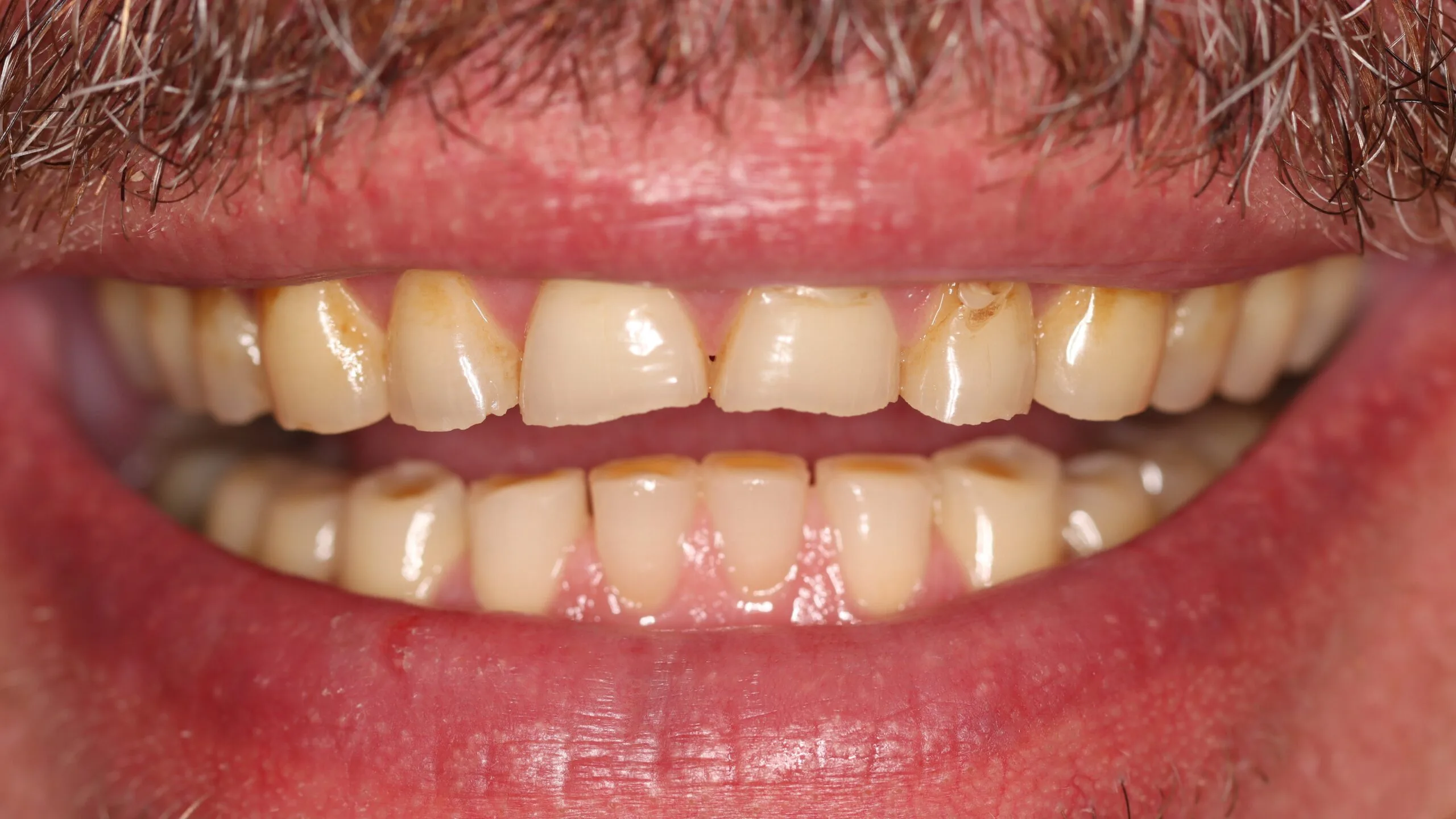 Before Smile Makeover Cosmetic Dentistry Natural Dr Chalita le Roux scaled