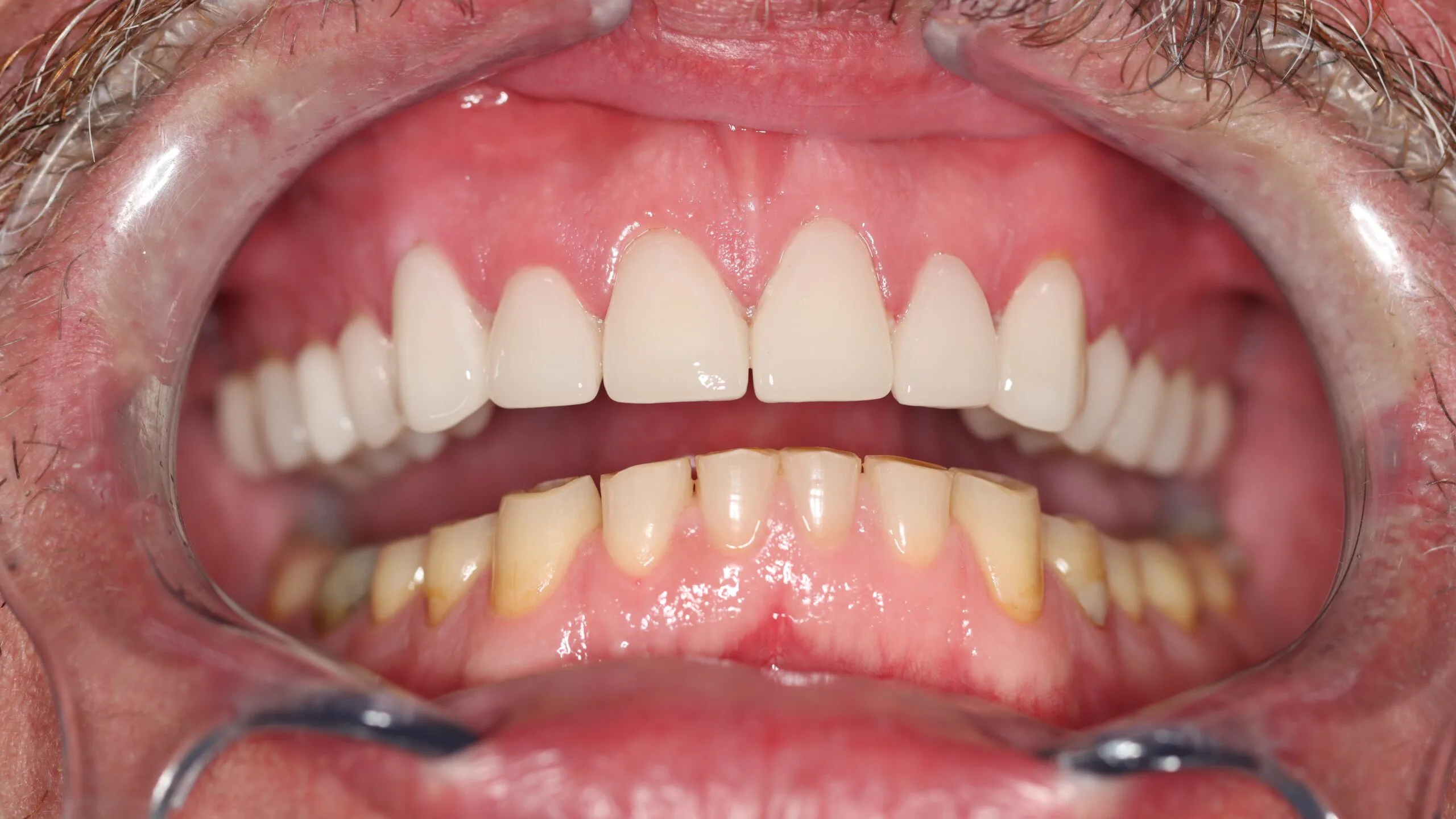Dental crown preparation during cosmetic dentistry smile makeover in Roodepoort.