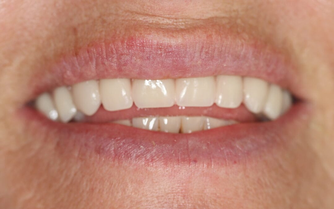 Natural-looking dental implant smile result Johannesburg by Dr Chalita le Roux