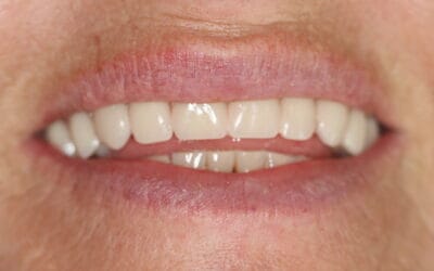 HOME 3 What Do All-on-4 Dental Implants Cost in South Africa? | Dr Chalita le Roux