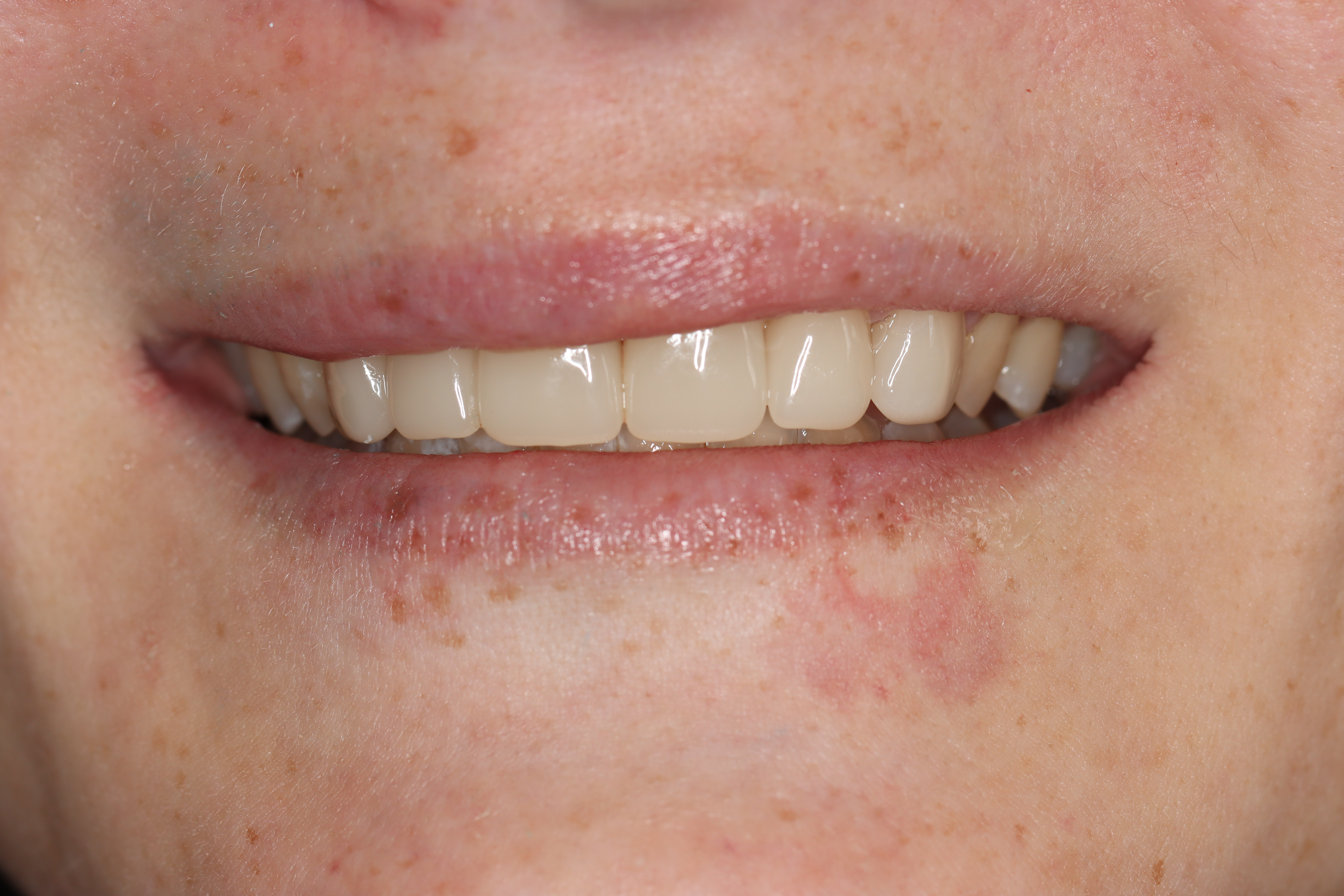 3-unit dental bridge — after — Dr Chalita le Roux Inc., Amorosa Office Park 3-unit dental bridge replacing a missing upper-front tooth — after, Dr Chalita le Roux, Roodepoort