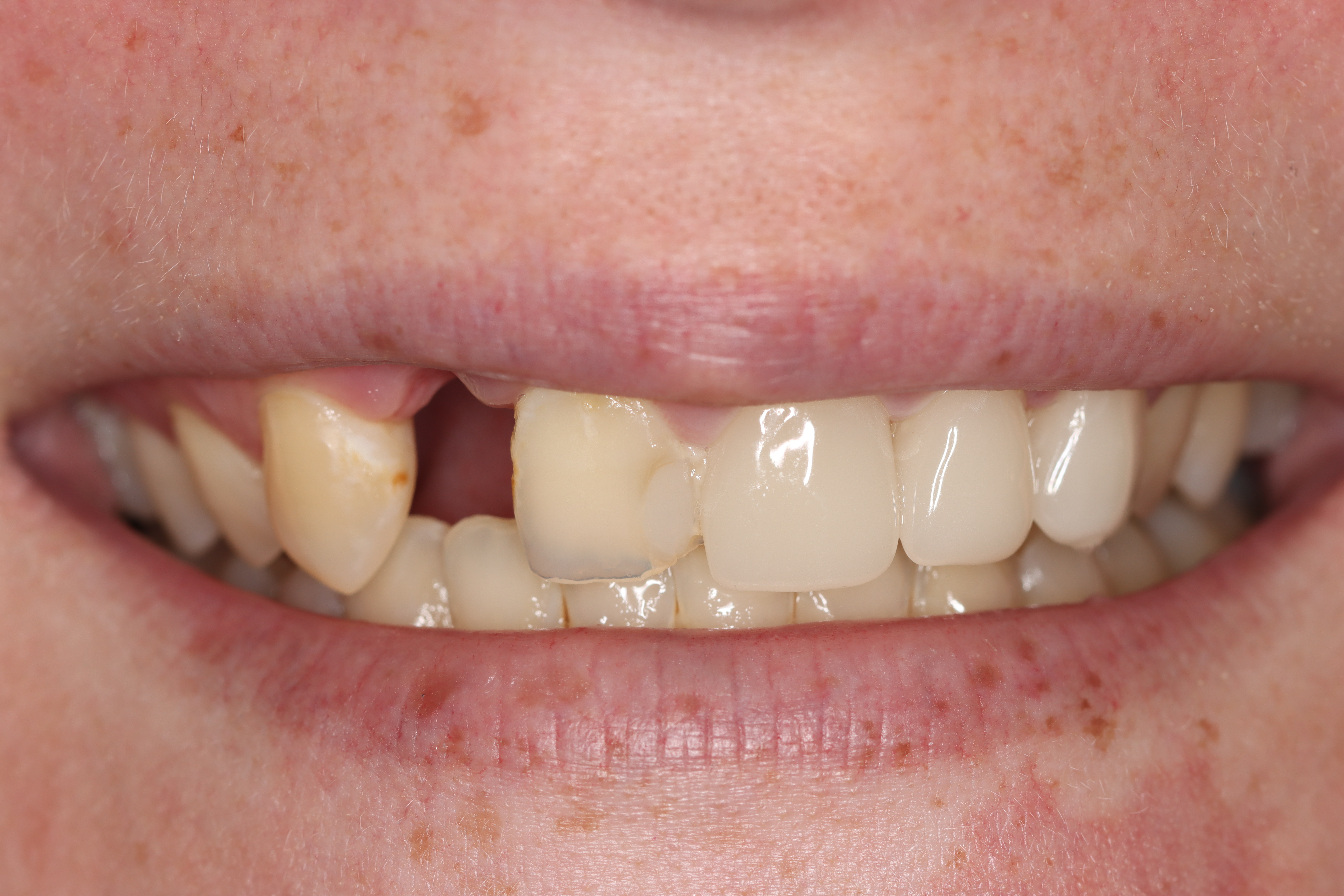 3-unit dental bridge replacing a missing upper-front tooth — before, Dr Chalita le Roux, Roodepoort