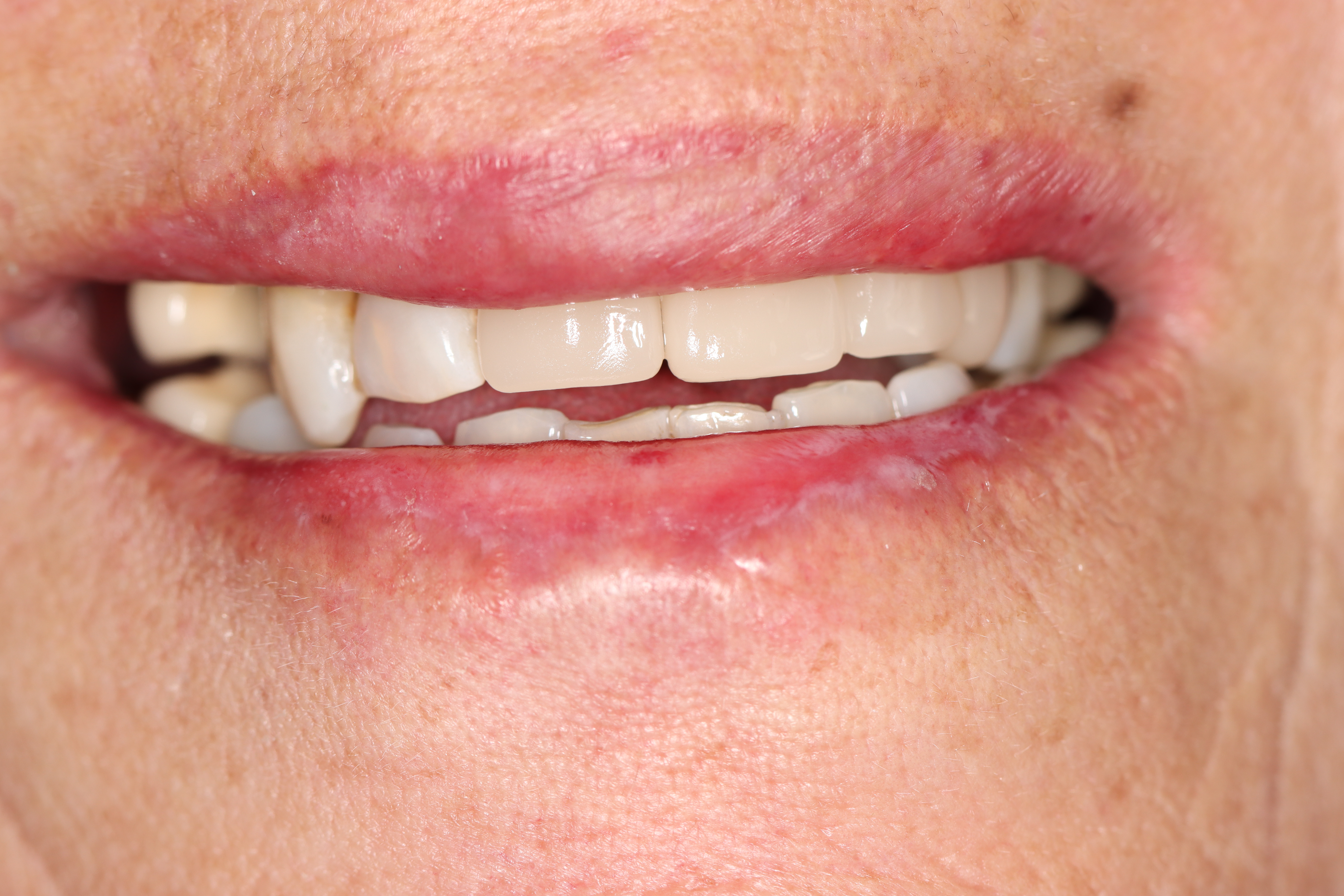 Dental bridge anterior — after — Dr Chalita le Roux Inc., Amorosa Office Park Dental bridge replacing a missing anterior tooth — after, Dr Chalita le Roux, Roodepoort