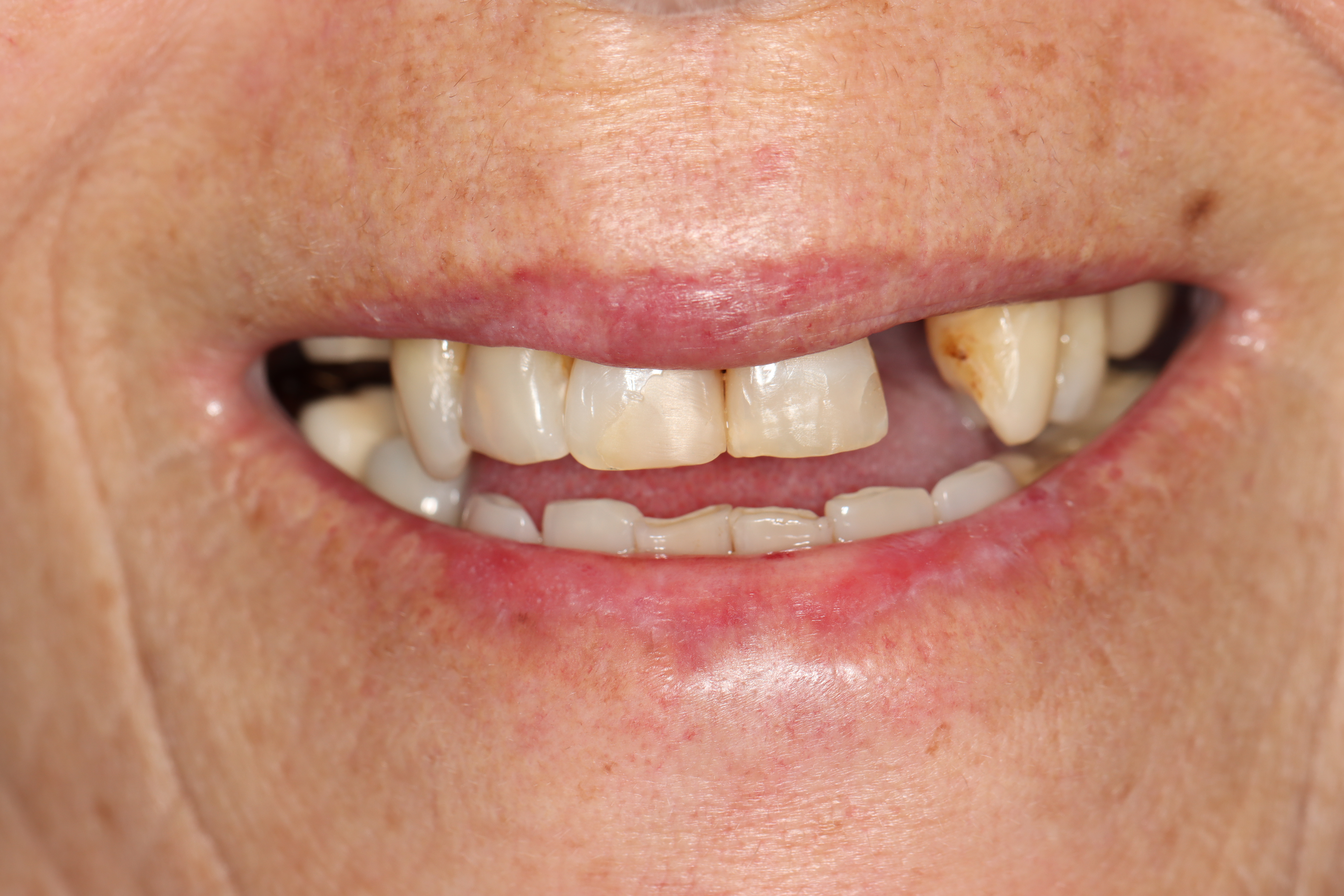 Dental bridge replacing a missing anterior tooth — before, Dr Chalita le Roux, Roodepoort